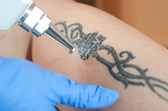 Tattoo Removal Methods – Everything You Need to Know