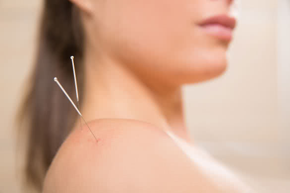 Acupuncture needle pricking on woman shoulder therapy