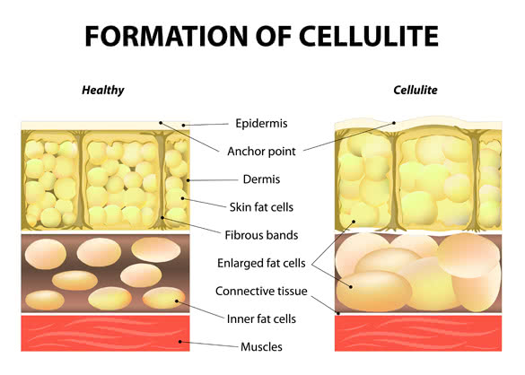 Illustration-of-skin-cross-section-showing-cellulite