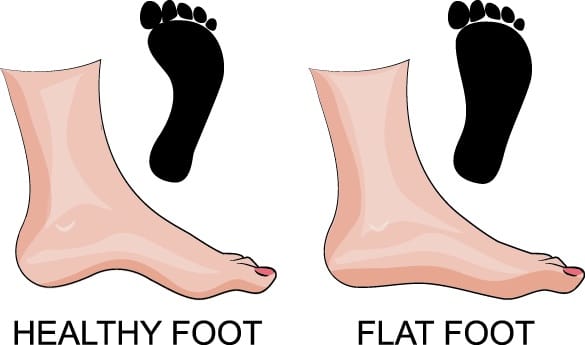 flat feet